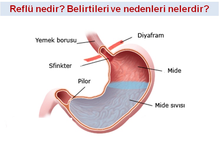 Reflü Belirtileri Nelerdir?